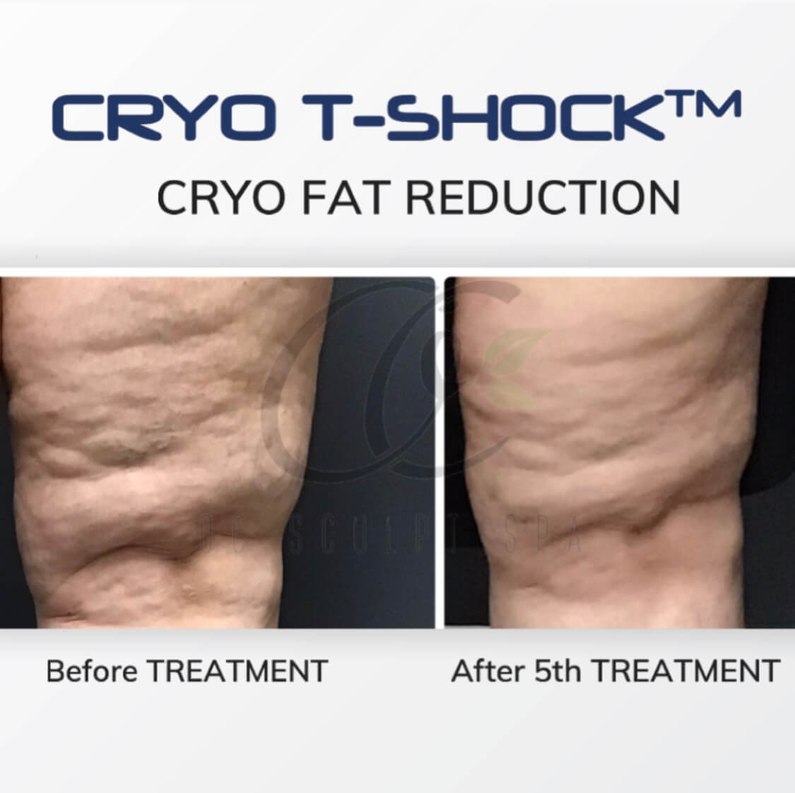 Cryo T Shock Fat Removal Front Thigh