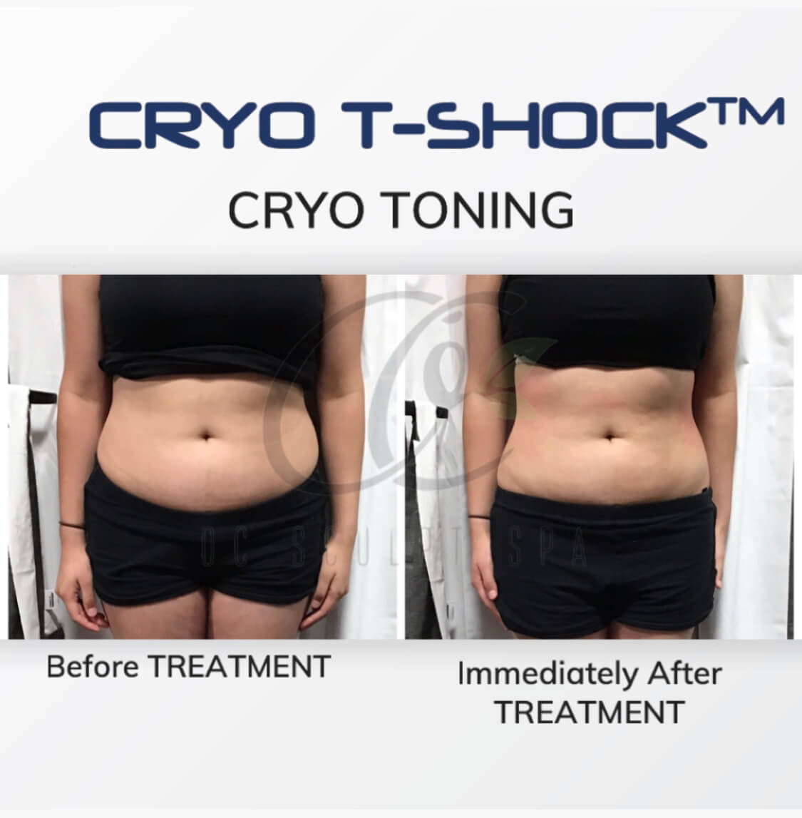 Cryo T Shock Toning on Stomach and Abdomen