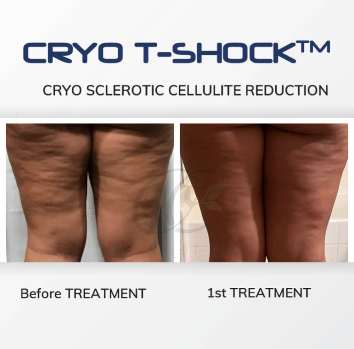 Cryo T Shock Sclerotic Cellulite Treatment