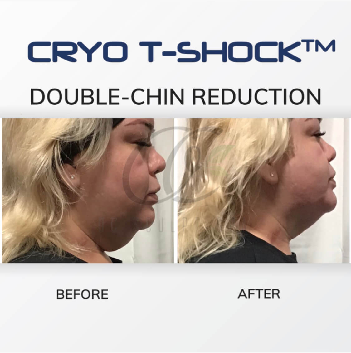 Cryo T Shock Double-chin reduction